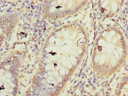 Immunohistochemistry of paraffin-embedded human colon cancer using CSB-PA726395LA01HU at dilution of 1:100