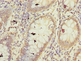 Immunohistochemistry of paraffin-embedded human colon cancer using CSB-PA726395LA01HU at dilution of 1:100