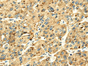The image on the left is immunohistochemistry of paraffin-embedded Human liver cancer tissue using CSB-PA727078(SENP2 Antibody) at dilution 1/20, on the right is treated with fusion protein. (Original magnification: ×200)