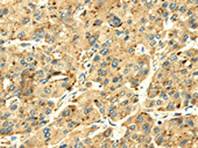 The image on the left is immunohistochemistry of paraffin-embedded Human liver cancer tissue using CSB-PA727078(SENP2 Antibody) at dilution 1/20, on the right is treated with fusion protein. (Original magnification: ×200)