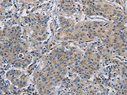 The image on the left is immunohistochemistry of paraffin-embedded Human gastric cancer tissue using CSB-PA727123(DNAJB4 Antibody) at dilution 1/50, on the right is treated with fusion protein. (Original magnification: ×200)