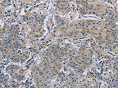 The image on the left is immunohistochemistry of paraffin-embedded Human gastric cancer tissue using CSB-PA727123(DNAJB4 Antibody) at dilution 1/50, on the right is treated with fusion protein. (Original magnification: ×200)