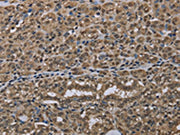 The image on the left is immunohistochemistry of paraffin-embedded Human thyroid cancer tissue using CSB-PA727351(NLRP6 Antibody) at dilution 1/50, on the right is treated with synthetic peptide. (Original magnification: ×200)