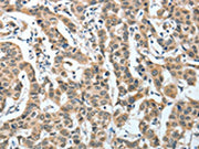 The image on the left is immunohistochemistry of paraffin-embedded Human breast cancer tissue using CSB-PA727952(IL1R1 Antibody) at dilution 1/25, on the right is treated with fusion protein. (Original magnification: ×200)