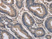 The image on the left is immunohistochemistry of paraffin-embedded Human colon cancer tissue using CSB-PA728154(KCND1 Antibody) at dilution 1/20, on the right is treated with synthetic peptide. (Original magnification: ×200)