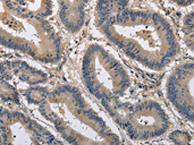 The image on the left is immunohistochemistry of paraffin-embedded Human colon cancer tissue using CSB-PA728154(KCND1 Antibody) at dilution 1/20, on the right is treated with synthetic peptide. (Original magnification: ×200)