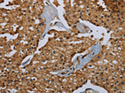 The image on the left is immunohistochemistry of paraffin-embedded Human prostate cancer tissue using CSB-PA728668(ID2 Antibody) at dilution 1/30, on the right is treated with fusion protein. (Original magnification: ×200)