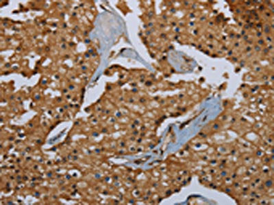 The image on the left is immunohistochemistry of paraffin-embedded Human prostate cancer tissue using CSB-PA728668(ID2 Antibody) at dilution 1/30, on the right is treated with fusion protein. (Original magnification: ×200)