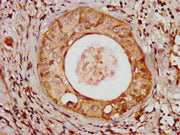 IHC image of CSB-PA728898LA01HU diluted at 1:100 and staining in paraffin-embedded human cervical cancer performed on a Leica BondTM system. After dewaxing and hydration, antigen retrieval was mediated by high pressure in a citrate buffer (pH 6.0)...