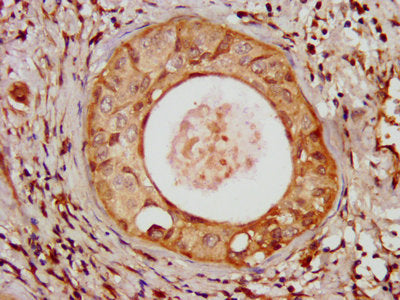 IHC image of CSB-PA728898LA01HU diluted at 1:100 and staining in paraffin-embedded human cervical cancer performed on a Leica BondTM system. After dewaxing and hydration, antigen retrieval was mediated by high pressure in a citrate buffer (pH 6.0)...