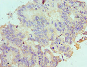 Immunohistochemistry of paraffin-embedded human colon cancer using CSB-PA729190ESR2HU at dilution of 1:100