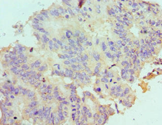Immunohistochemistry of paraffin-embedded human colon cancer using CSB-PA729190ESR2HU at dilution of 1:100