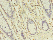 Immunohistochemistry of paraffin-embedded human colon cancer using CSB-PA729201LA01HU at dilution of 1:100