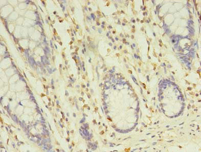 Immunohistochemistry of paraffin-embedded human colon cancer using CSB-PA729201LA01HU at dilution of 1:100