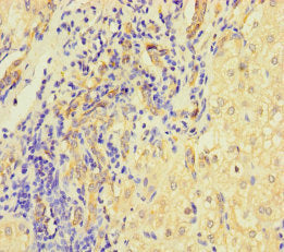 Immunohistochemistry of paraffin-embedded human liver cancer using CSB-PA729208LA01HU at dilution of 1:100