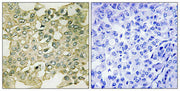 Immunohistochemical analysis of paraffin-embedded human breast carcinoma tissue using MYT1 (Phospho-Ser83) antibody (left)or the same antibody preincubated with blocking peptide (right).