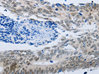 The image on the left is immunohistochemistry of paraffin-embedded Human colon cancer tissue using CSB-PA729577(MMP21 Antibody) at dilution 1/45, on the right is treated with synthetic peptide. (Original magnification: ×200)