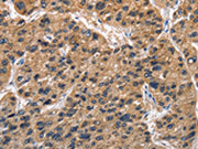 The image on the left is immunohistochemistry of paraffin-embedded Human liver cancer tissue using CSB-PA729627(ABI3BP Antibody) at dilution 1/50, on the right is treated with fusion protein. (Original magnification: ×200)