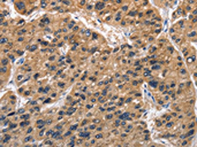 The image on the left is immunohistochemistry of paraffin-embedded Human liver cancer tissue using CSB-PA729627(ABI3BP Antibody) at dilution 1/50, on the right is treated with fusion protein. (Original magnification: ×200)