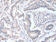 The image on the left is immunohistochemistry of paraffin-embedded Human colon cancer tissue using CSB-PA729731(ACOT9 Antibody) at dilution 1/15, on the right is treated with fusion protein. (Original magnification: ×200)