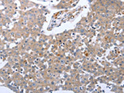 The image on the left is immunohistochemistry of paraffin-embedded Human breast cancer tissue using CSB-PA729792(RASSF1 Antibody) at dilution 1/30, on the right is treated with synthetic peptide. (Original magnification: ×200)
