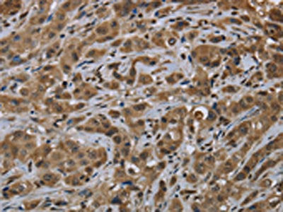 The image on the left is immunohistochemistry of paraffin-embedded Human breast cancer tissue using CSB-PA729928(FTO Antibody) at dilution 1/60, on the right is treated with fusion protein. (Original magnification: ×200)