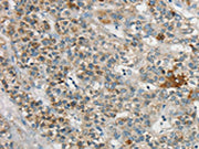The image on the left is immunohistochemistry of paraffin-embedded Human liver cancer tissue using CSB-PA729972(SYCP3 Antibody) at dilution 1/20, on the right is treated with synthetic peptide. (Original magnification: ×200)