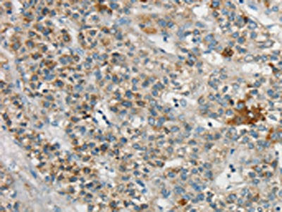 The image on the left is immunohistochemistry of paraffin-embedded Human liver cancer tissue using CSB-PA729972(SYCP3 Antibody) at dilution 1/20, on the right is treated with synthetic peptide. (Original magnification: ×200)