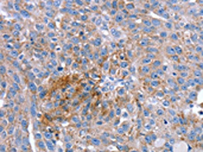 The image on the left is immunohistochemistry of paraffin-embedded Human breast cancer tissue using CSB-PA729987(SPATA5L1 Antibody) at dilution 1/20, on the right is treated with synthetic peptide. (Original magnification: ×200)