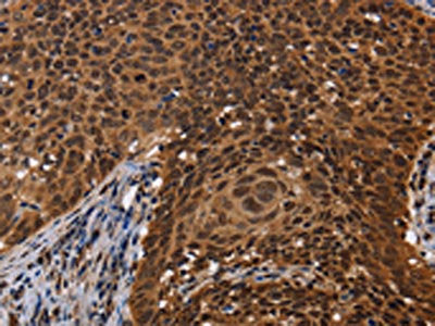 The image on the left is immunohistochemistry of paraffin-embedded Human cervical cancer tissue using CSB-PA730045(FASTKD5 Antibody) at dilution 1/40, on the right is treated with fusion protein. (Original magnification: ×200)