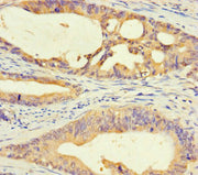 Immunohistochemistry of paraffin-embedded human colon cancer using CSB-PA730143LA01HU at dilution of 1:100