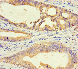 Immunohistochemistry of paraffin-embedded human colon cancer using CSB-PA730143LA01HU at dilution of 1:100