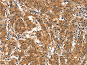 The image on the left is immunohistochemistry of paraffin-embedded Human gastic cancer tissue using CSB-PA731077(EID3 Antibody) at dilution 1/15, on the right is treated with synthetic peptide. (Original magnification: ×200)