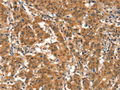 The image on the left is immunohistochemistry of paraffin-embedded Human gastic cancer tissue using CSB-PA731077(EID3 Antibody) at dilution 1/15, on the right is treated with synthetic peptide. (Original magnification: ×200)