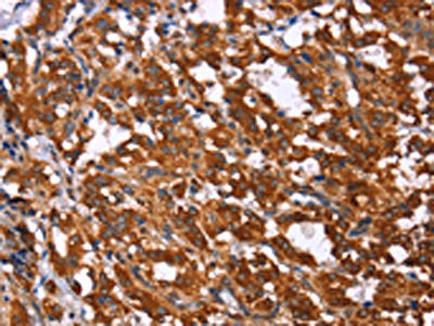 The image on the left is immunohistochemistry of paraffin-embedded Human thyroid cancer tissue using CSB-PA732036(GPR65 Antibody) at dilution 1/15, on the right is treated with synthetic peptide. (Original magnification: ×200)
