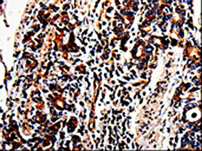 The image on the left is immunohistochemistry of paraffin-embedded Human stomach cancer tissue using CSB-PA732422(ACSBG2 Antibody) at dilution 1/60, on the right is treated with fusion protein. (Original magnification: ×200)
