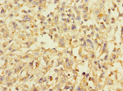 Immunohistochemistry of paraffin-embedded human melanoma using CSB-PA732925LA01HU at dilution of 1:100