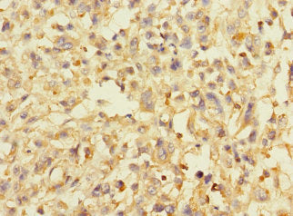 Immunohistochemistry of paraffin-embedded human melanoma using CSB-PA732925LA01HU at dilution of 1:100