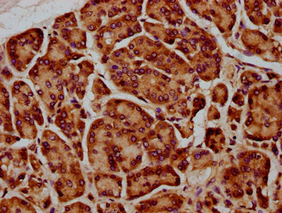 IHC image of CSB-PA732939LA01HU diluted at 1:400 and staining in paraffin-embedded human pancreatic cancer performed on a Leica BondTM system. After dewaxing and hydration, antigen retrieval was mediated by high pressure in a citrate buffer (pH 6....