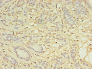Immunohistochemistry of paraffin-embedded human breast cancer using CSB-PA732978LA01HU at dilution of 1:100