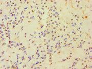 Immunohistochemistry of paraffin-embedded human breast cancer using CSB-PA734652ESR2HU at dilution of 1:100