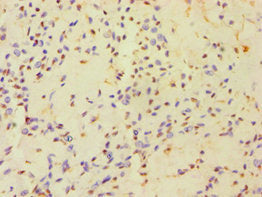 Immunohistochemistry of paraffin-embedded human breast cancer using CSB-PA734652ESR2HU at dilution of 1:100