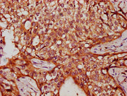 IHC image of CSB-PA735951LA01HU diluted at 1:300 and staining in paraffin-embedded human cervical cancer performed on a Leica BondTM system. After dewaxing and hydration, antigen retrieval was mediated by high pressure in a citrate buffer (pH 6.0)...