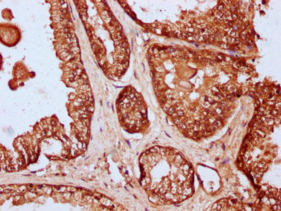 IHC image of CSB-PA735979LA01HU diluted at 1:200 and staining in paraffin-embedded human prostate cancer performed on a Leica BondTM system. After dewaxing and hydration, antigen retrieval was mediated by high pressure in a citrate buffer (pH 6.0)...