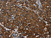 The image on the left is immunohistochemistry of paraffin-embedded Human breast cancer tissue using CSB-PA736786(ERBB4 Antibody) at dilution 1/40, on the right is treated with fusion protein. (Original magnification: ×200)