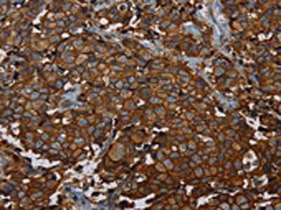 The image on the left is immunohistochemistry of paraffin-embedded Human breast cancer tissue using CSB-PA736786(ERBB4 Antibody) at dilution 1/40, on the right is treated with fusion protein. (Original magnification: ×200)