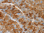The image on the left is immunohistochemistry of paraffin-embedded Human liver cancer tissue using CSB-PA736913(ALDOB Antibody) at dilution 1/55, on the right is treated with synthetic peptide. (Original magnification: ×200)