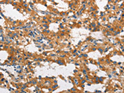 The image on the left is immunohistochemistry of paraffin-embedded Human thyroid cancer tissue using CSB-PA736949(CLTC Antibody) at dilution 1/60, on the right is treated with synthetic peptide. (Original magnification: ×200)