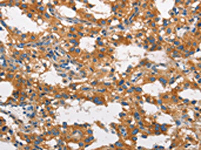 The image on the left is immunohistochemistry of paraffin-embedded Human thyroid cancer tissue using CSB-PA736949(CLTC Antibody) at dilution 1/60, on the right is treated with synthetic peptide. (Original magnification: ×200)
