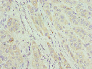 Immunohistochemistry of paraffin-embedded human liver cancer using CSB-PA738750ESR1HU at dilution of 1:100